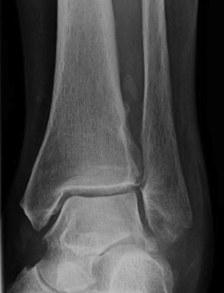 Ankle Interossesous MO following high ankle sprain